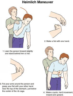 Emergency Medicine: Choking - The Heimlich Maneuver