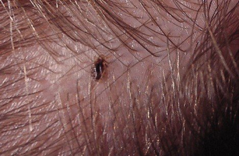 head lice treatment