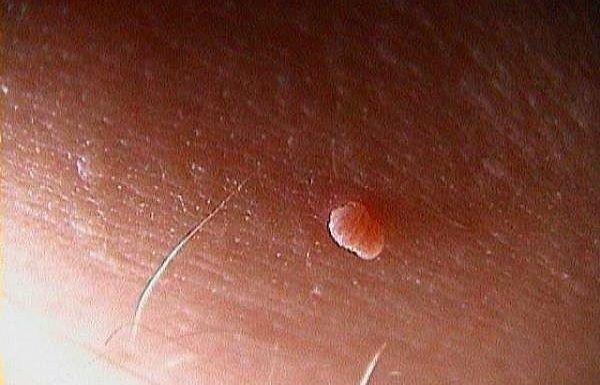 skin tags e1486616273610