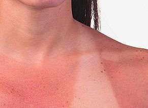 sunburn 291 20090604 165713 e1483112636101